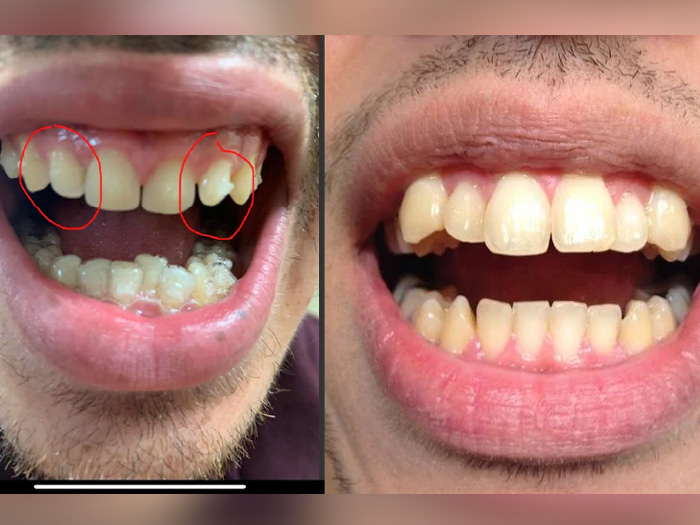 Mewing results for crooked teeth before & after